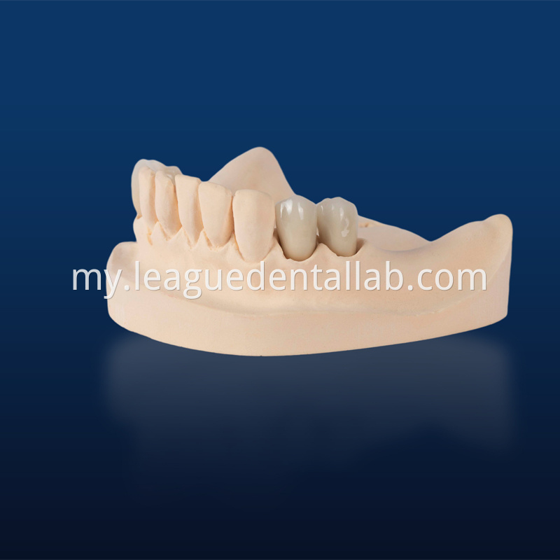 PFZ,Porcelain Fused to Zirconia,Zirconia Layered, Zirconia Veneered